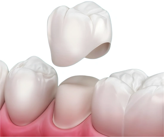 Dental Crowns