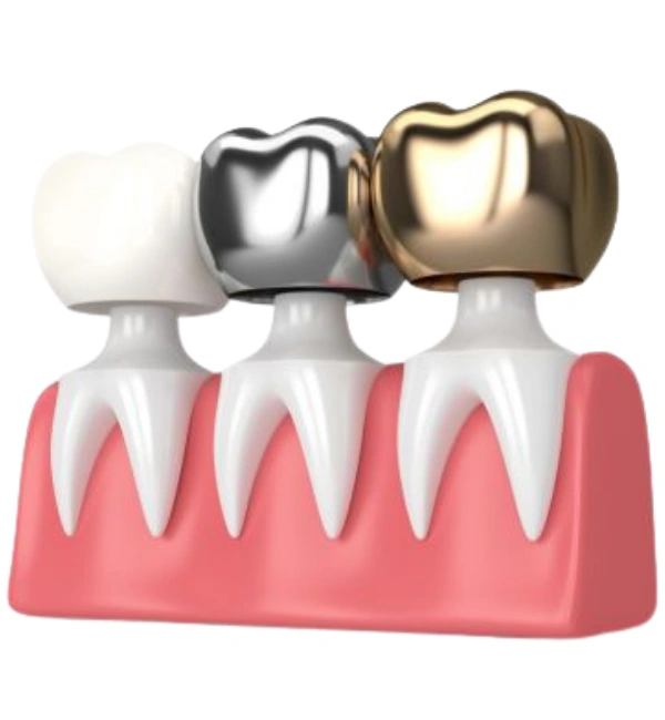 Dental Crowns