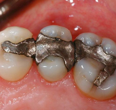 FULL MOUTH DENTAL IMPLANTS