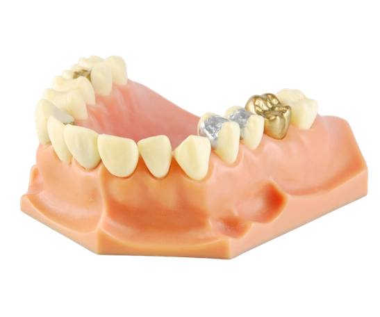 Dental Fillings