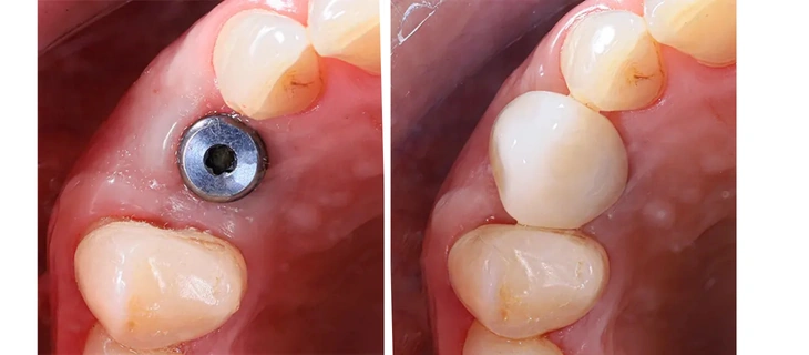 Dental Implants