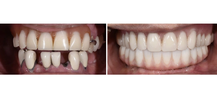 Dental Implants