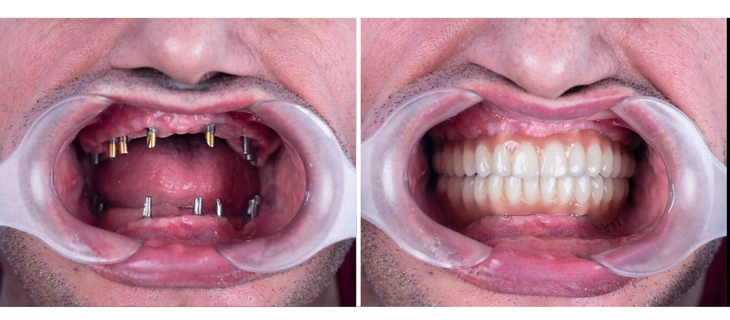 Dental Implants
