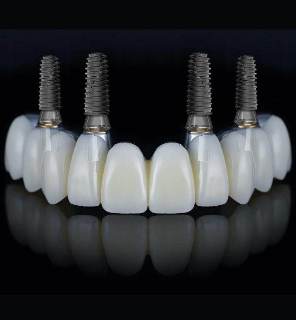 Dental Implants