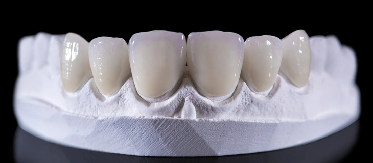 Dental Veneers