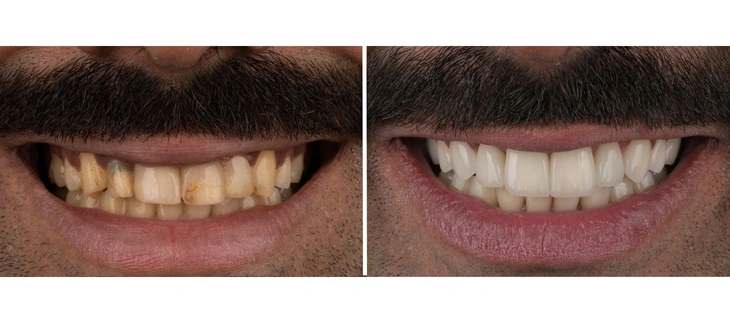 Dental Veneers