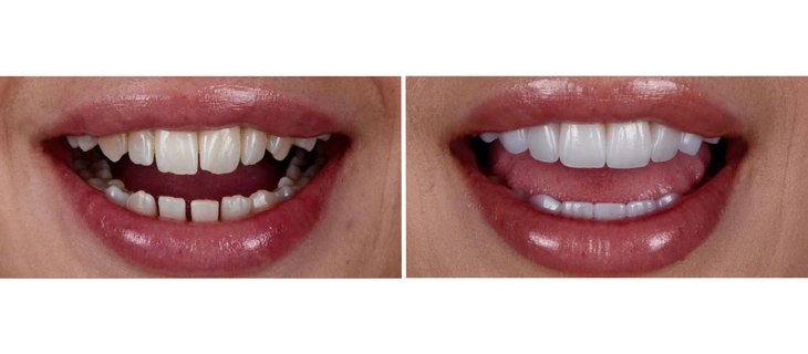 Dental Veneers