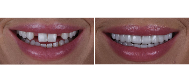 Dental Veneers