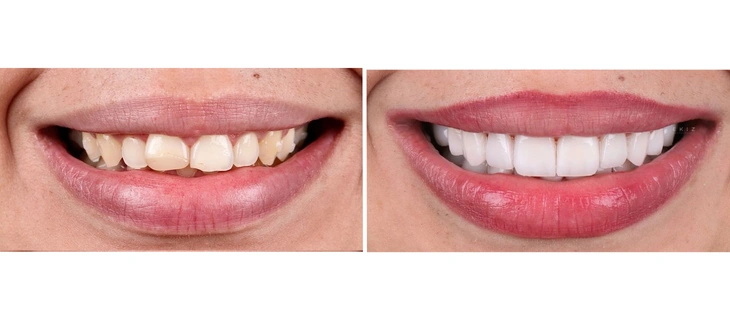 Dental Veneers