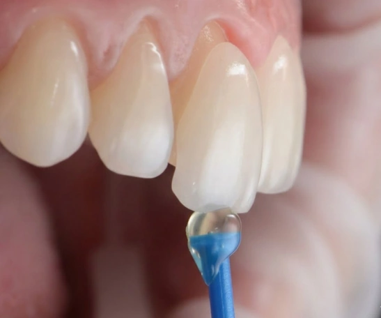 Dental Veneers