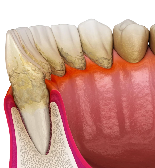 Dentist for Scaling and Root Planing in
                                    Bandra Eas