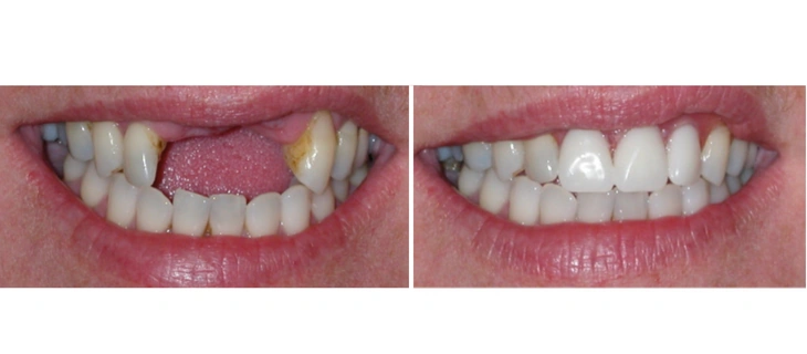 Dentures