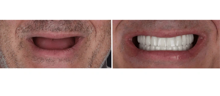 Dentures