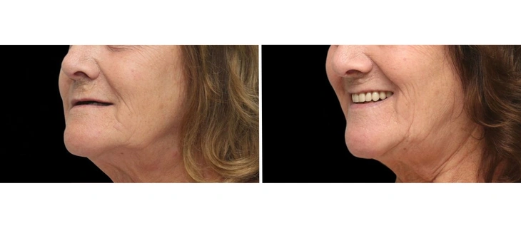 Dentures
