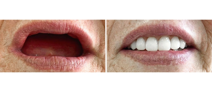 Dentures