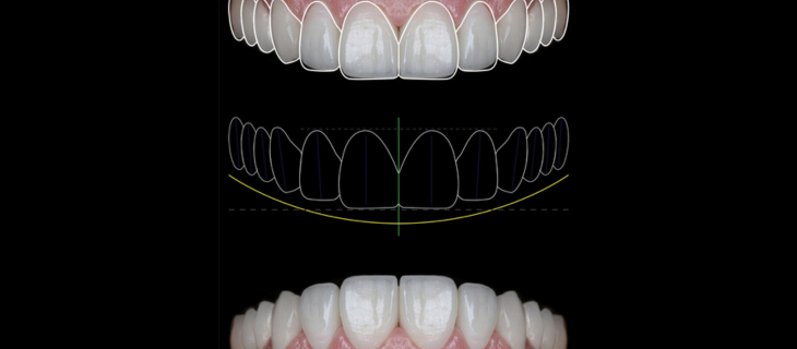 Designing Your Smile Digitally