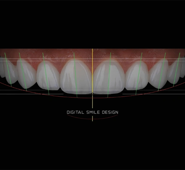 Digital Smile Design