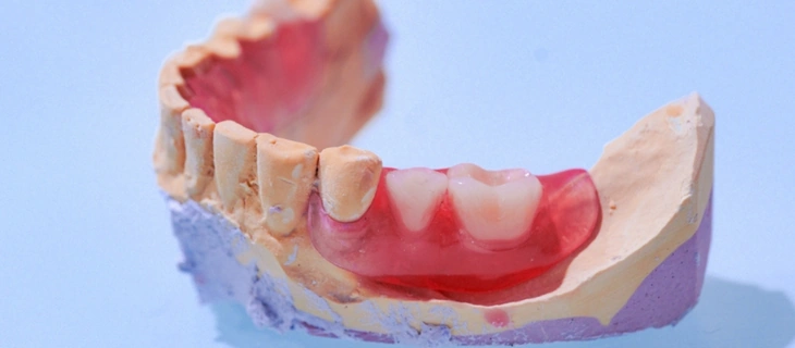 Final Denture Placement