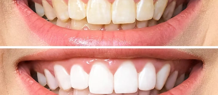 Teeth Whitening