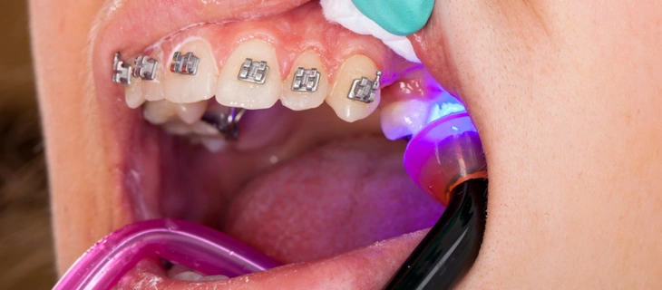Fixing the Brackets