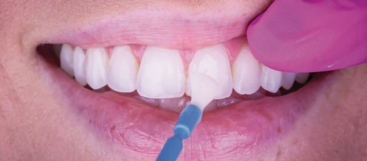 Fluoride Treatment