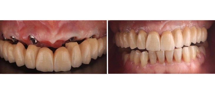 Full Mouth Dental Implants