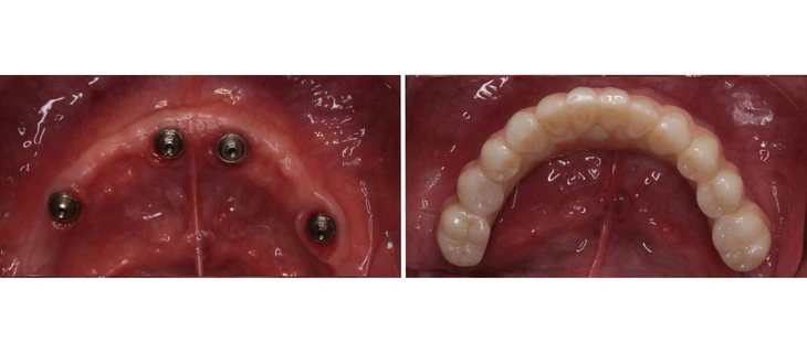 Full Mouth Dental Implants