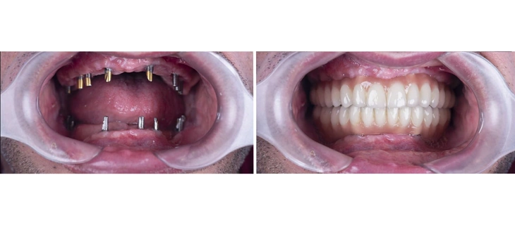 Full Mouth Dental Implants