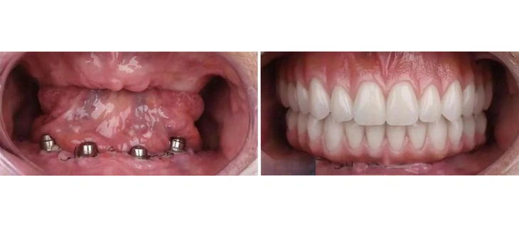 Full Mouth Dental Implants