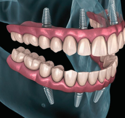 FULL MOUTH DENTAL IMPLANTS