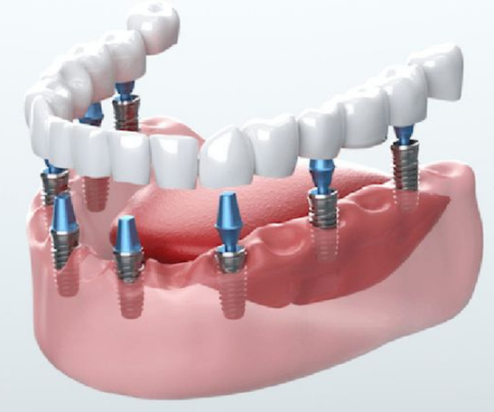 Full Mouth Dental Implants in Bandra
