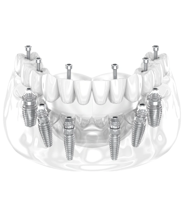 Full Mouth Dental Implants