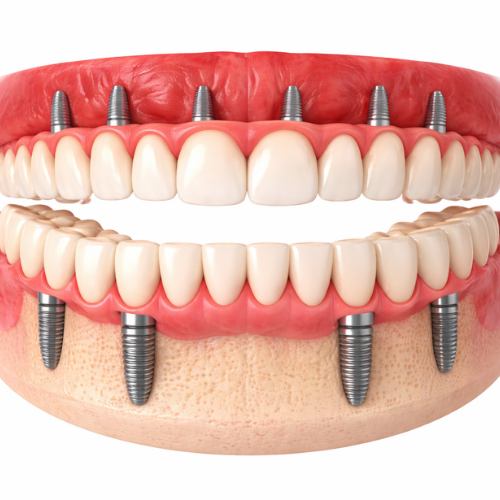Full Mouth Dental Implants