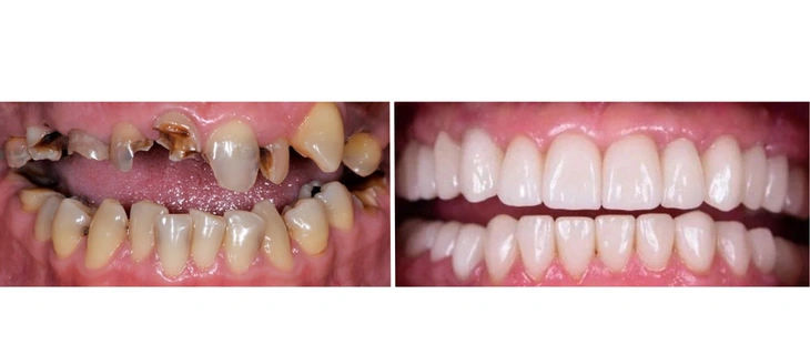 Full Mouth Rehabilitation