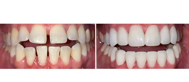 Full Mouth Rehabilitation