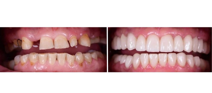 Full Mouth Rehabilitation