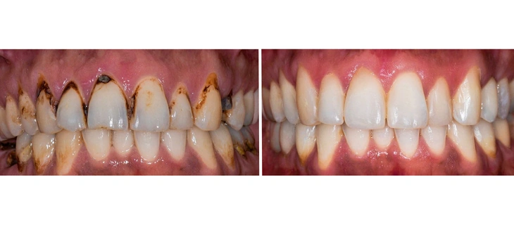 Full Mouth Rehabilitation