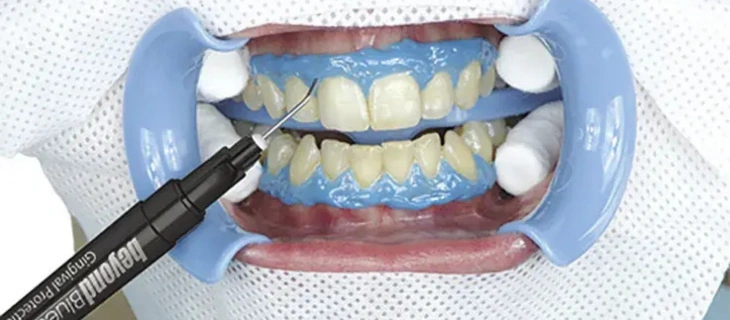 Teeth Whitening