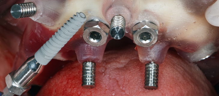 Placing the First Aligner