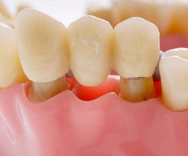 Dental Bridges Benefits