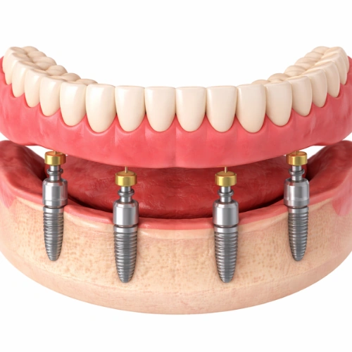 Implant Supported Denture Treatment