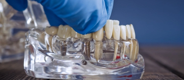 Full Mouth Dental Implants