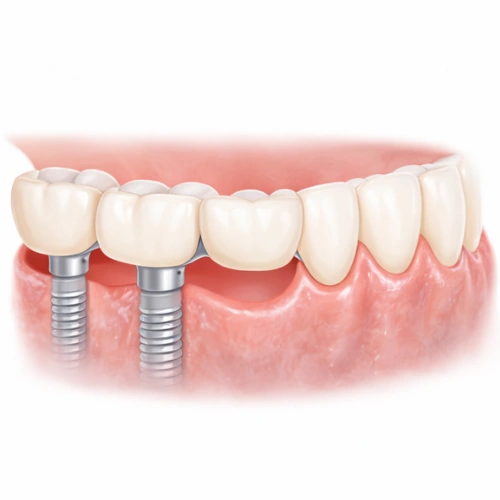 Dental Bridges