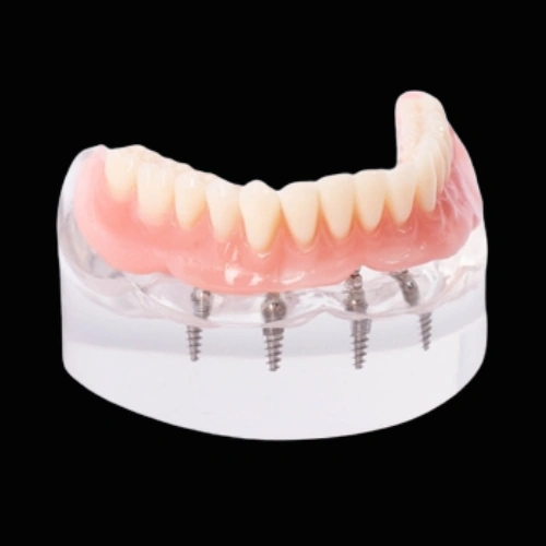 Implant-Supported Dentures