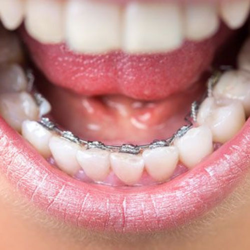 Lingual Braces