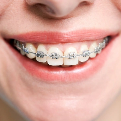 Metal Braces