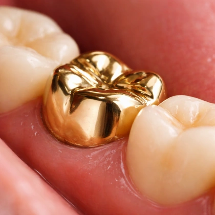 Metal Crowns