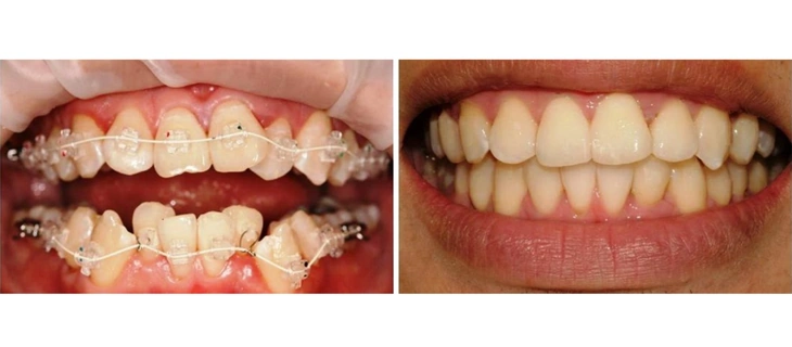 Teeth Braces