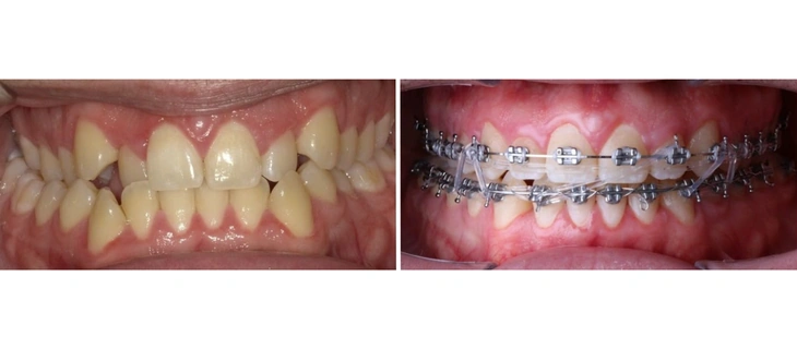 Teeth Braces