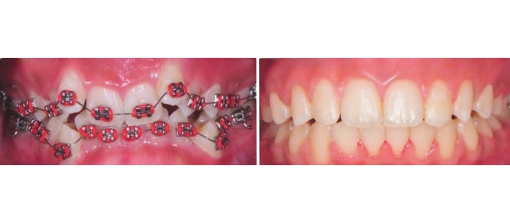 Teeth Braces